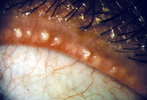 blepharitis images #11