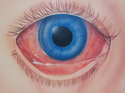 Commonly known as Pink Eye, conjunctivitis is an infection of the 