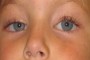 Image showing congenital ptosis in the right eye