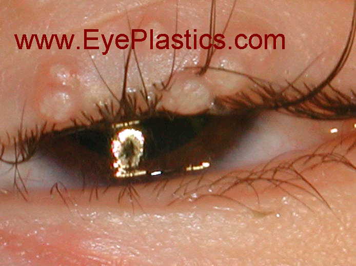 Eyelid molluscum with associated follicular conjunctivitis