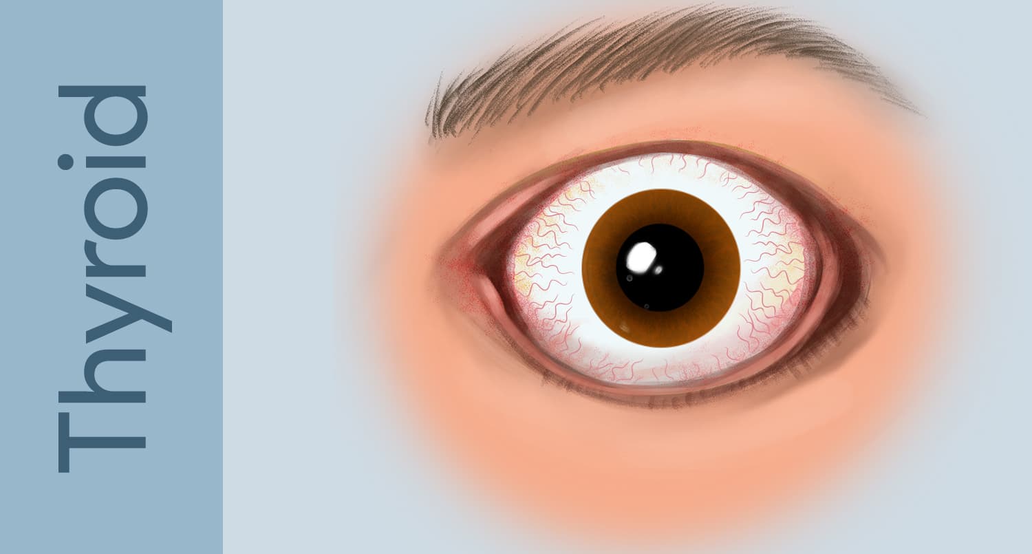 Thyroid Eye Disease