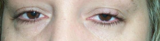 Ambos lados, izquierdo más bajo que derecho (ptosis asimétrico)