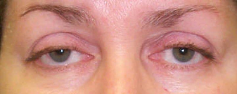 Ambos párpados superiores caídos, cubriendo parcialmente los ojos