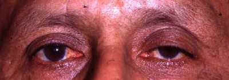 Margen del párpado bajo con pliegue palpebral alto, ambos lados — ptosis involutivo (aponeurótico)