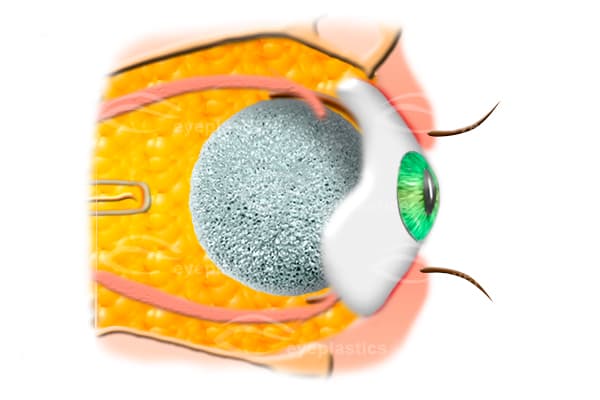 Prótesis ocular ajustada en la órbita