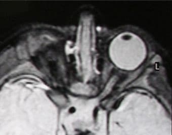 MRI de la órbita demostrando una órbita anoftálmica