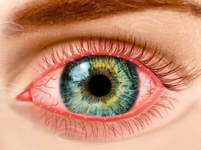 Apariencia clínica de blefaritis: márgenes palpebrales rojos inflamados con inyección conjuntival
