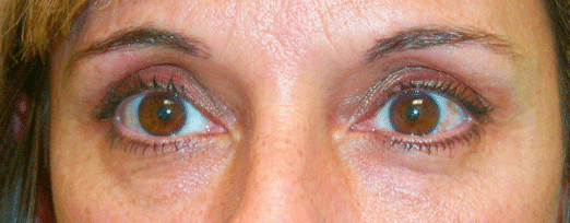 Before β Age 44