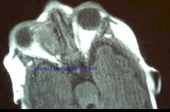 Eyelid capillary hemangioma encroaching on the visual axis