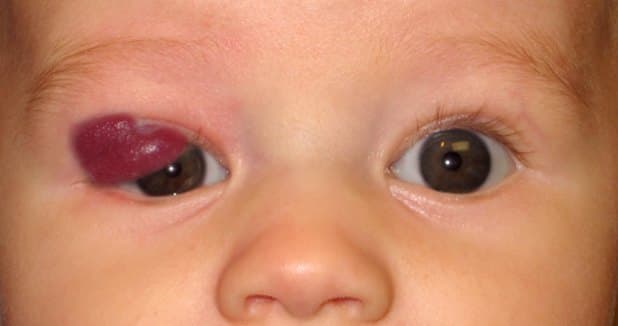 Hemangioma capilar (de fresa) que afecta el párpado de un lactante