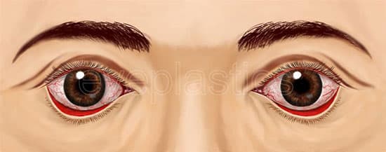 Clinical photograph of ectropion — lower eyelid turning outward