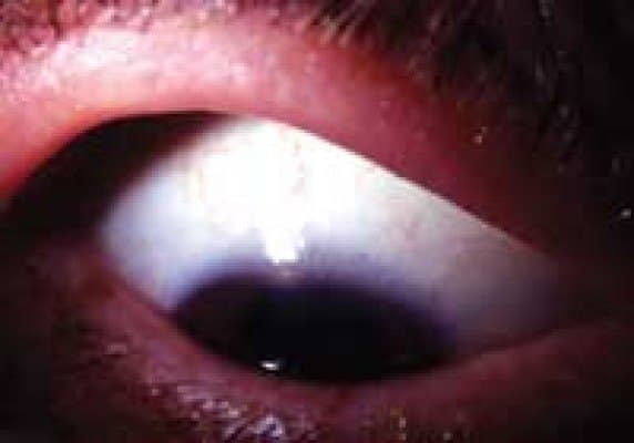 Easy eversion of the upper eyelid with only minimal upward traction — the hallmark sign of floppy eyelid syndrome