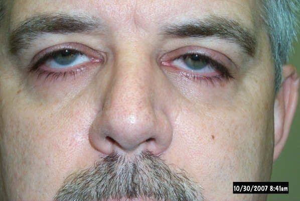Lash ptosis — downward-pointing upper lashes