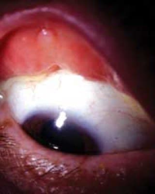Marked upper eyelid laxity and poor lid-globe congruity