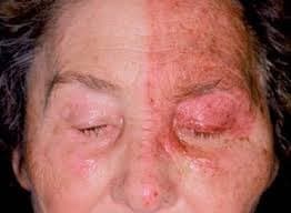 Herpes zóster oftálmico — exantema dermatómico unilateral con inflamación de párpados