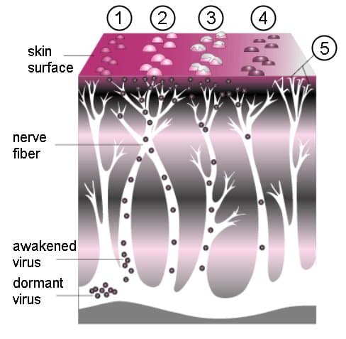 Curso del herpes zóster — pápula a vesícula a costra
