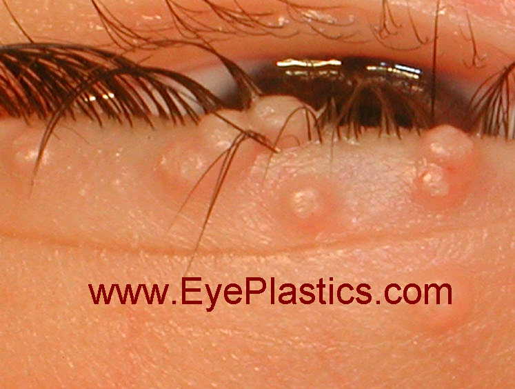 Molusco contagioso —primer plano de pápulas palpebrales
