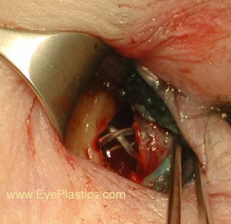 Cirurgia DCR — exposição da região do saco lacrimal