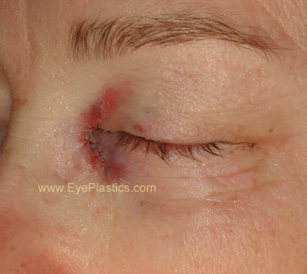 Cirurgia DCR — o saco lacrimal aberto e nova passagem para o nariz