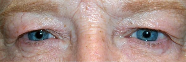 Dermatochalasis — exceso de piel del párpado superior sobresaliendo un margen normal del párpado