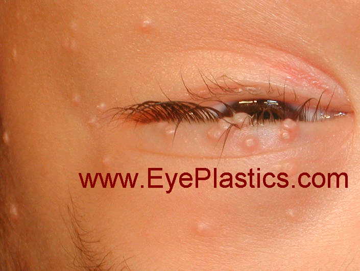 Molluscum Contagiosum of the Eyelid