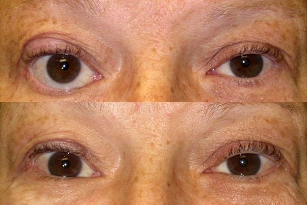 Eyelid Spacer Grafts (TarSys & Alternatives)