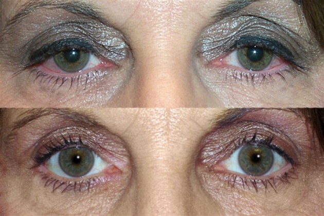 Cosmetic eyelid surgery, oculofacial Oculo-facial) surgeon locate