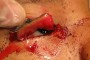 Image depicting a right upper lid margin avulsion