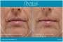 Image depicting front smile lines