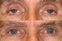 Before and after image of a 81-year-old patient following ptosis surgery.