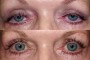 Image showing before and after ptosis surgery for a 52-year-old patient.