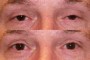 Before and after image of a 53-year-old patient undergoing ptosis surgery. The left side shows the condition before surgery, and the right side shows the improvement after surgery.