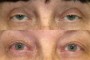 Image showing before and after results of ptosis surgery on a 59-year-old patient.
