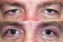 52-year-old patient before and after ptosis and blepharoplasty procedures, sourced from the National Database