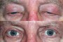 Before and after image of a 72-year-old patient showing ptosis and blepharoplasty results from the National Database.