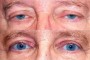 Before and after images of a 63-year-old patient showing ptosis and blepharoplasty results from the National Database.