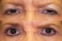 Before and after image showing ptosis and blepharoplasty. Text: '58y Before/After (From National Database) Ptosis and Blepharoplasty'