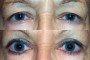 Before and after images of a 48-year-old patient showing Ptosis and Blepharoplasty results.