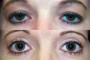 Image showing before and after of Ptosis and Blepharoplasty in a 34-year-old patient. From National Database.