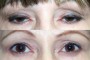 Before and after images of a 45-year-old patient undergoing Ptosis and Blepharoplasty surgery, sourced from the National Database. The first image shows ptosis, while the second image displays the post-operative result.