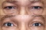 Before and after images of a 52-year-old patient undergoing ptosis and blepharoplasty, sourced from the National Database
