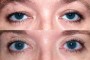 Before and after images of a 42-year-old patient showing ptosis and blepharoplasty. (From National Database)