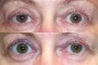 61-year-old patient before and after ptosis and blepharoplasty surgery, from the National Database