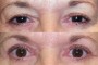 Before and after images of a 58-year-old patient showing results of ptosis and blepharoplasty surgery from the national database