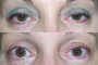Before and after images of a 52-year-old patient showing the results of ptosis correction and blepharoplasty, taken from the National Database.