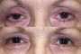 Before and after images showing ptosis and blepharoplasty results for a 55-year-old patient, from a national database