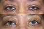 Image showing a 55-year-old patient before and after ptosis and blepharoplasty surgery, from the National Database.