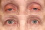 Before and after images of ptosis and blepharoplasty for a 75-year-old patient, as documented in the National Database.