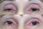 Before and after images of a 65-year-old patient showing ptosis correction and blepharoplasty results.