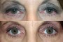 Before and after images of a 51-year-old patient who underwent ptosis and blepharoplasty surgery. The left image shows the patient before the procedure, and the right image shows the results after surgery.